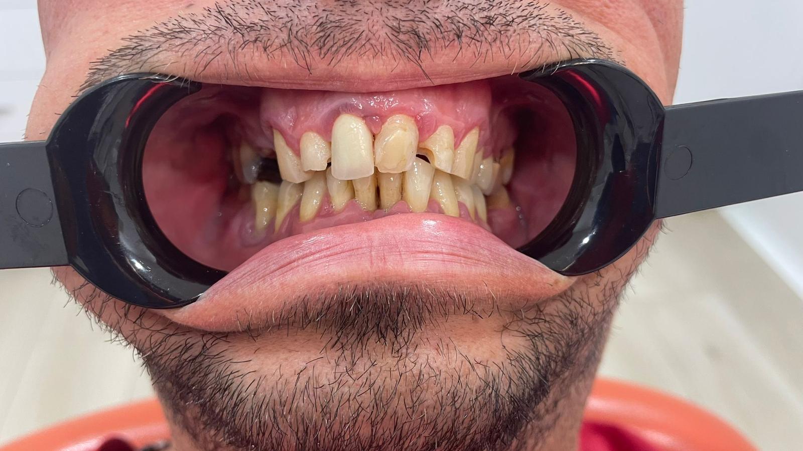 PUENTE METALPORCELANA SOBRE LOS DIENTES 1