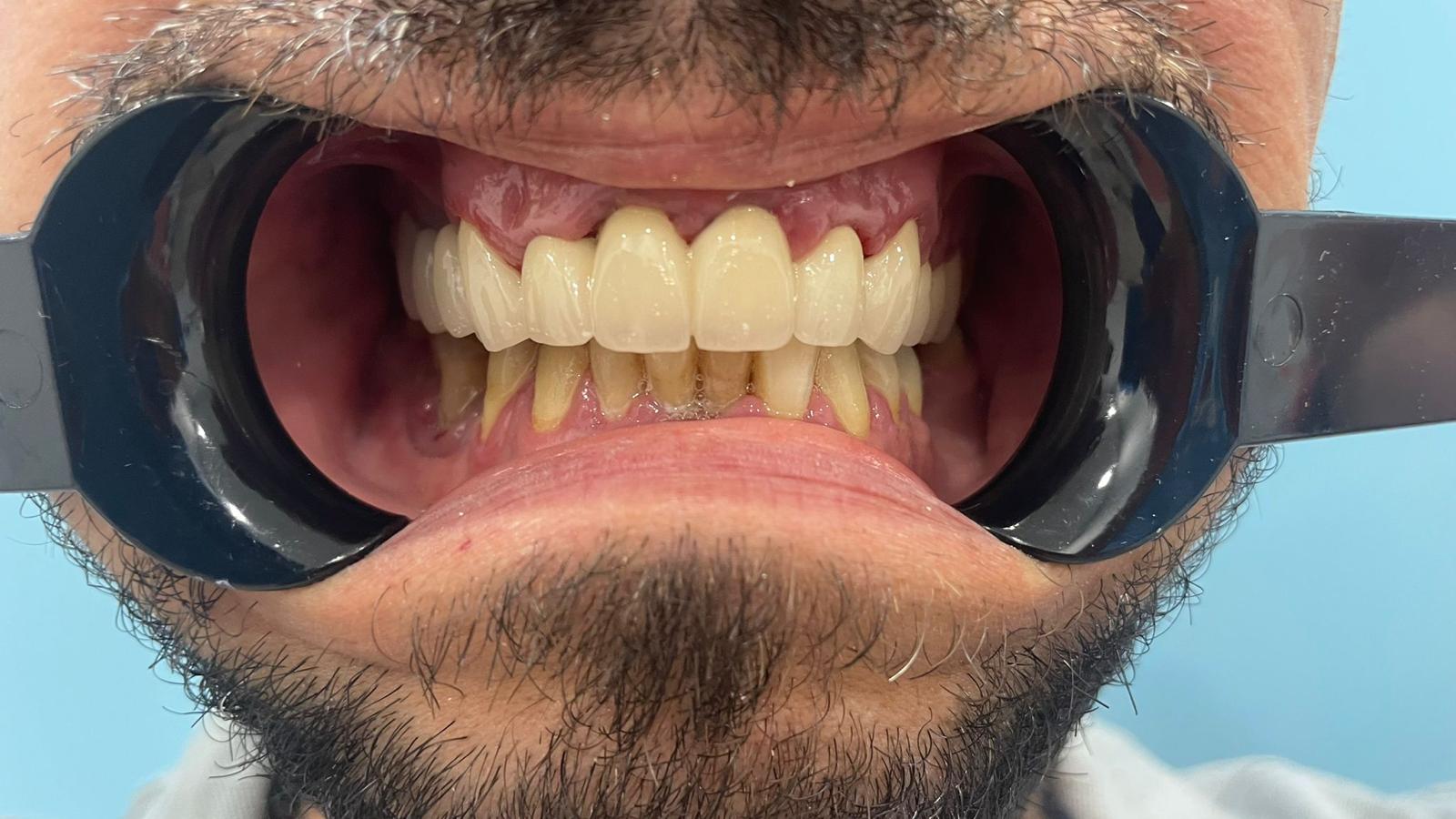 PUENTE METALPORCELANA SOBRE LOS DIENTES 2
