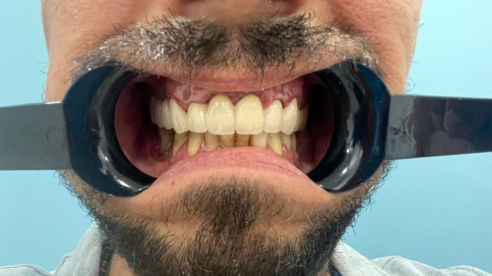 PUENTE METALPORCELANA SOBRE LOS DIENTES 3