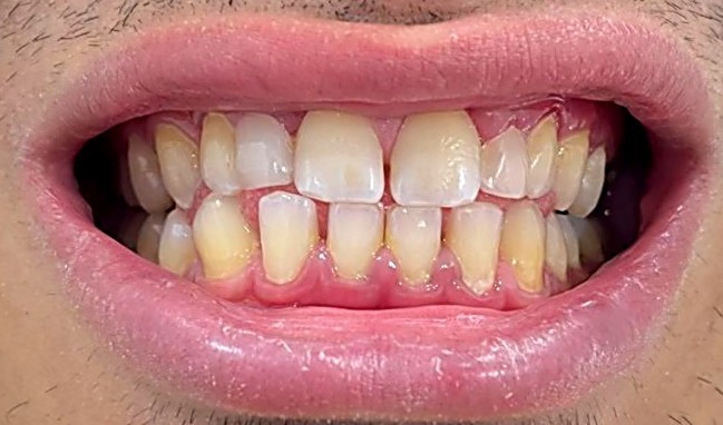 TARTAMIENTO_CARILLAS_DE_COMPOSITE_2