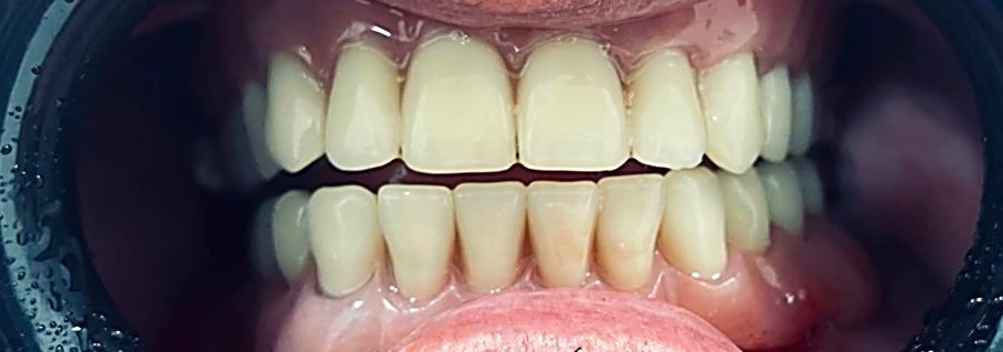 TRATAMIENTO_PROTESIS_COMPLETA_DE_ACRILICO_2_mejorada