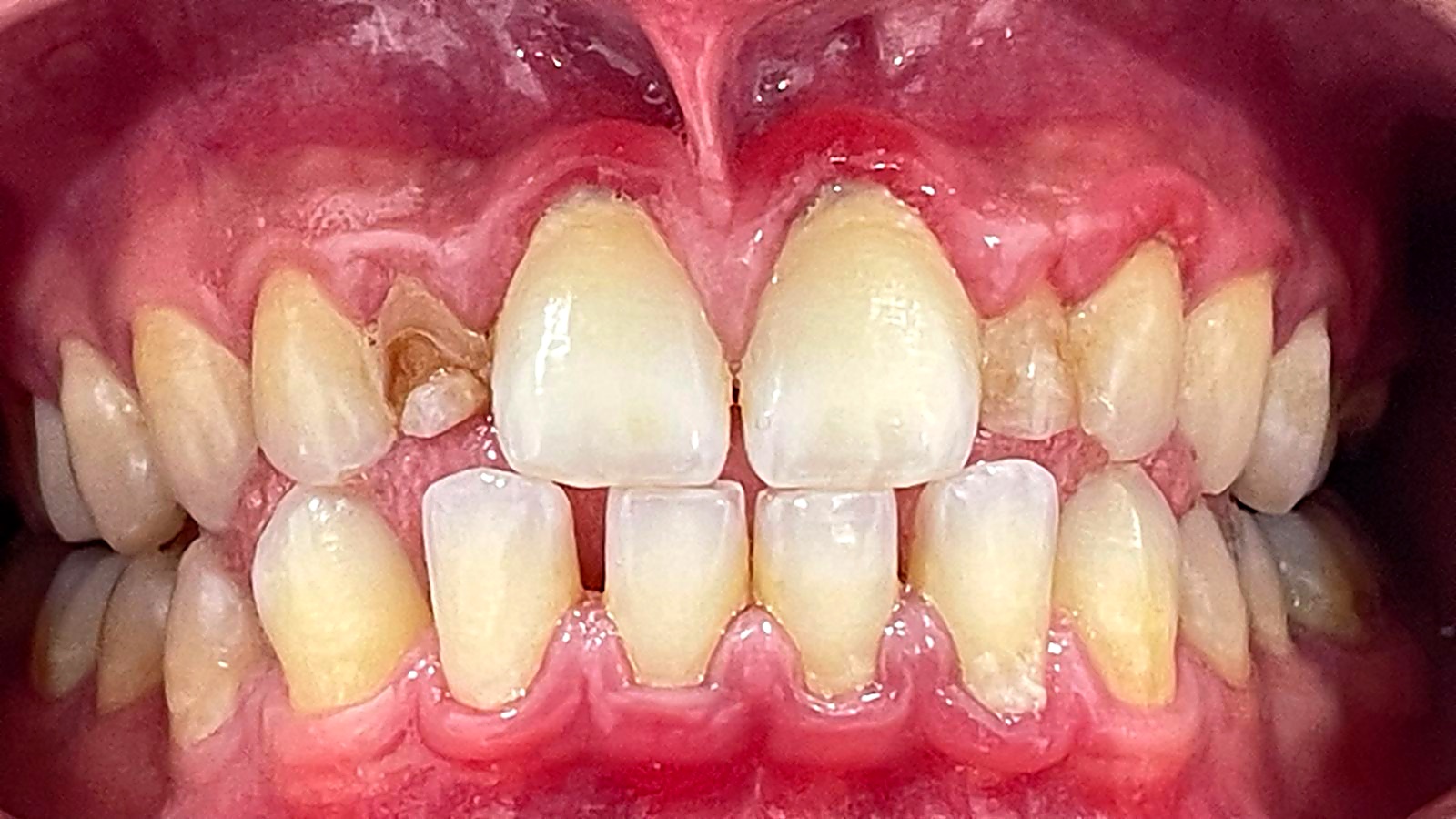 TRATAMIENTO__CARILLAS_DE_COMPOSITE_1