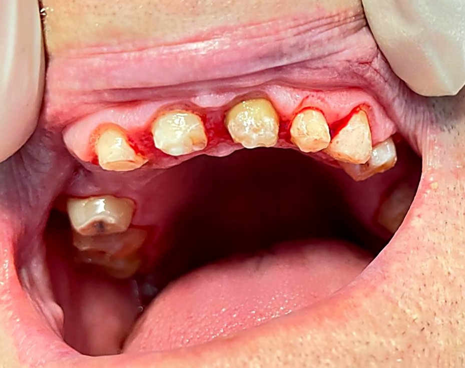 TRATAMIENTO__PUENTE_FIJO_SOBRE_DIENTES_1_mejorada (1)